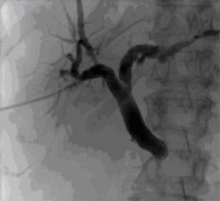 Externe Gallenwegsdrainage (PTCD) bei Gallenabflussstoerung infolge eines Pankreaskopftumors.